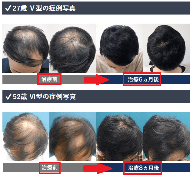 薄毛 芸能人 頭頂部 【2020年最新】頭頂部の薄毛に合うおすすめの髪型8選！ヘアセット方法や対策も紹介！
